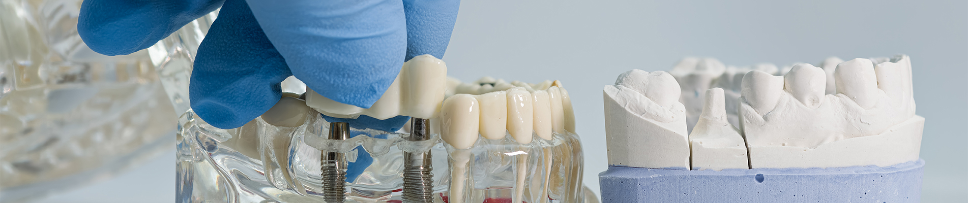 Implants vs Bridges: Replacing Missing Teeth