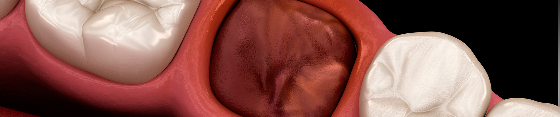 What is a Dry Socket and How to Prevent It