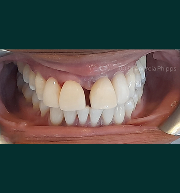 Successful dental restoration after emergency treatment in London - Case 1