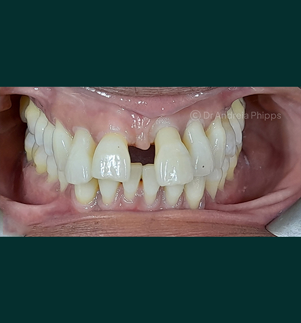 Dental condition before emergency treatment at London clinic - Case 1
