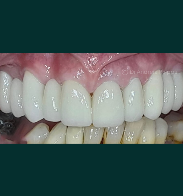 Restored tooth after same-day emergency dental care in London - Example 1