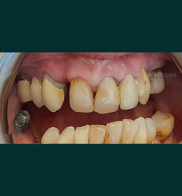Patient's tooth before emergency dental treatment in South Kensington - Example 1
