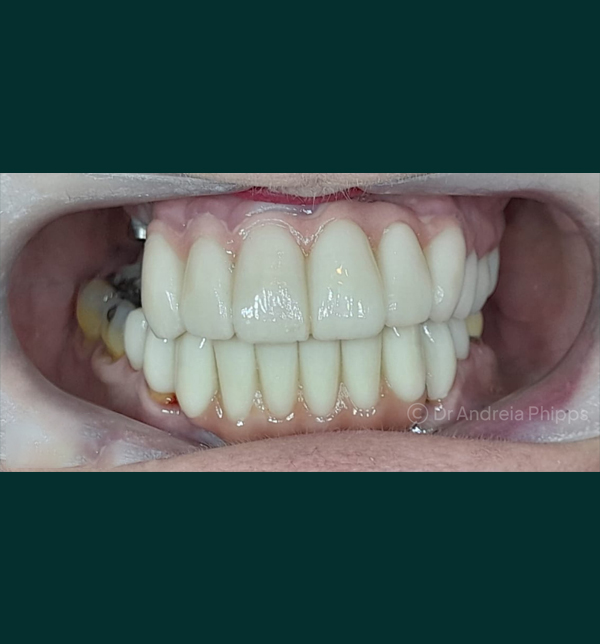 Restored tooth after same-day emergency dental care in London - Example 2