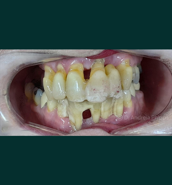 Patient's tooth before emergency dental treatment in South Kensington - Example 2