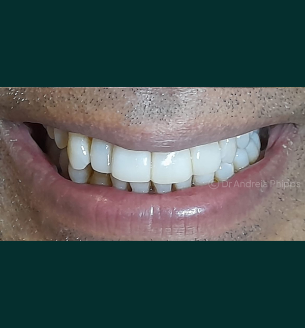 Successful dental restoration after emergency treatment in London - Case 2