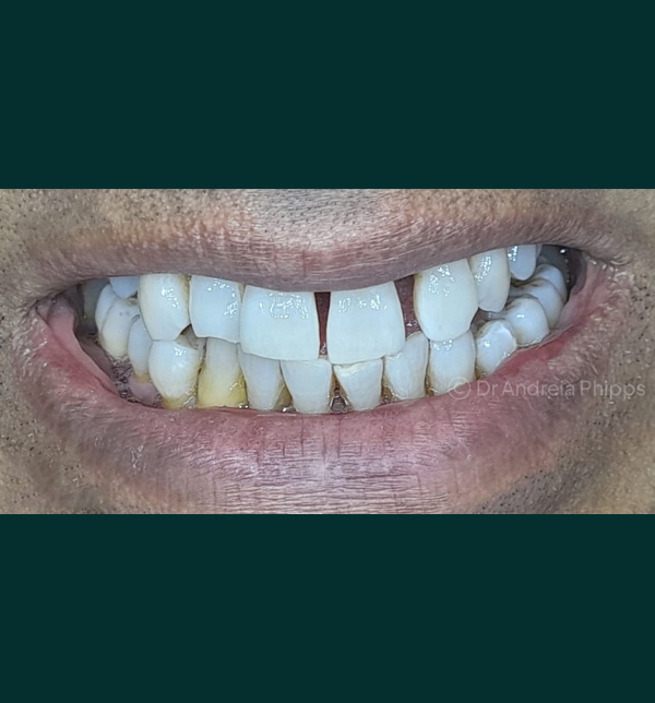 Dental condition before emergency treatment at London clinic - Case 2