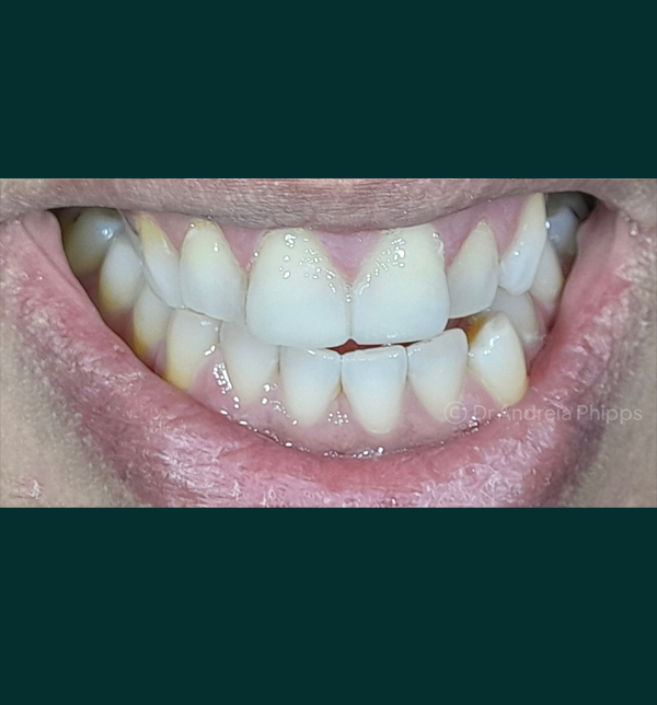 Successful dental restoration after emergency treatment in London - Case 3