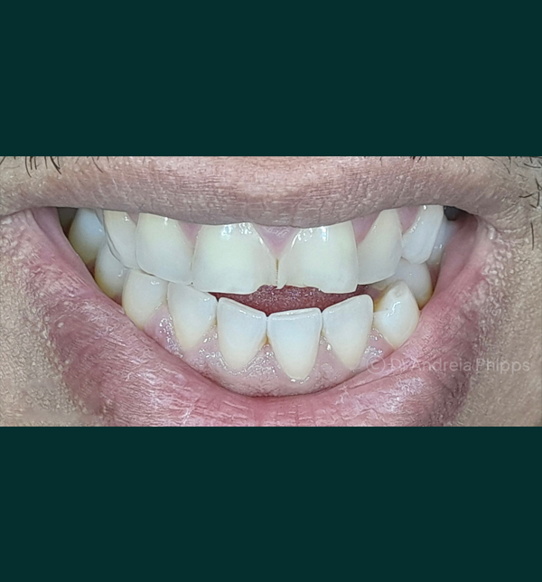 Dental condition before emergency treatment at London clinic - Case 3