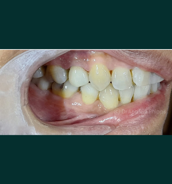 Successful dental restoration after emergency treatment in London - Case 4
