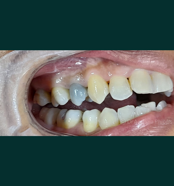 Dental condition before emergency treatment at London clinic - Case 4