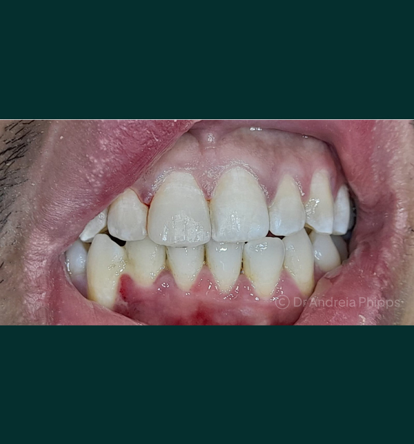 Restored smile after same-day composite bonding at London emergency dentist