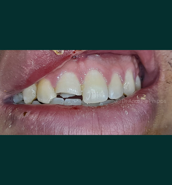 Chipped front tooth before emergency dental bonding treatment in London