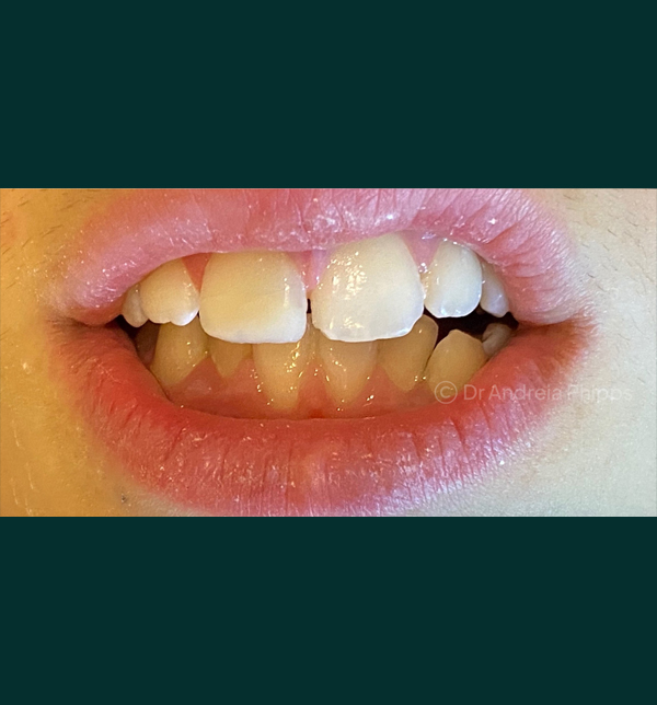 Successful dental restoration after emergency treatment in London - Case 6
