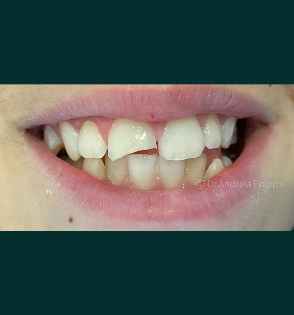 Dental condition before emergency treatment at London clinic - Case 6