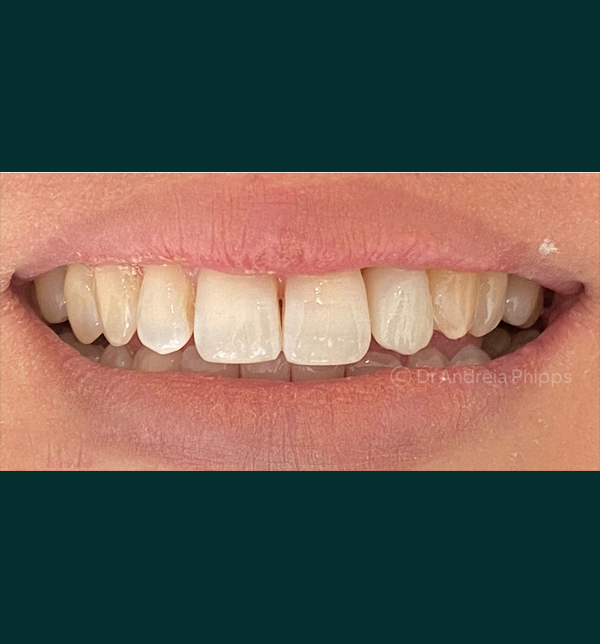 Successful dental restoration after emergency treatment in London - Case 7