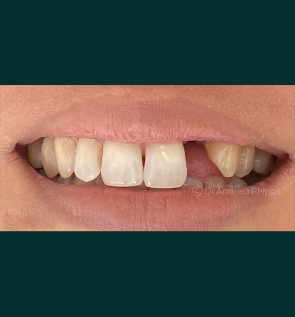Dental condition before emergency treatment at London clinic - Case 7