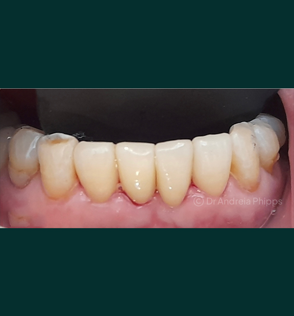 Successful dental restoration after emergency treatment in London - Case 8