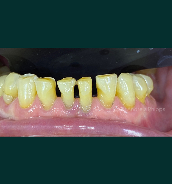Dental condition before emergency treatment at London clinic - Case 8