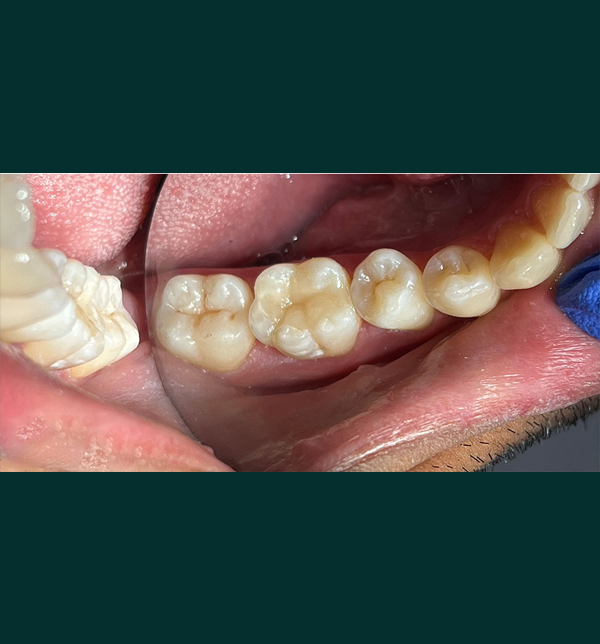 Restored tooth after same-day emergency dental care in London - Example 2