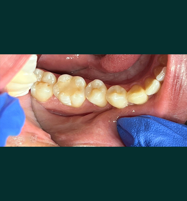 Patient's tooth before emergency dental treatment in South Kensington - Example 2
